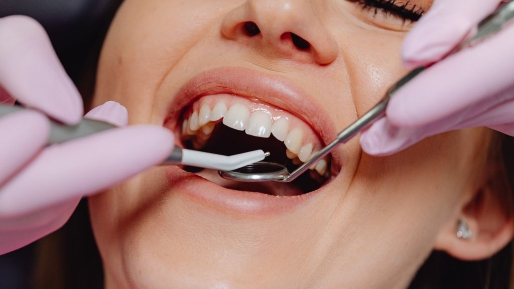 Dental Crowns in Los Angeles