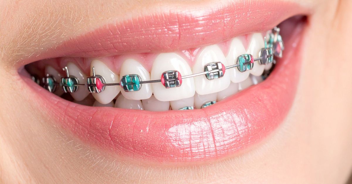 Emergency Braces Repair in Los Angeles