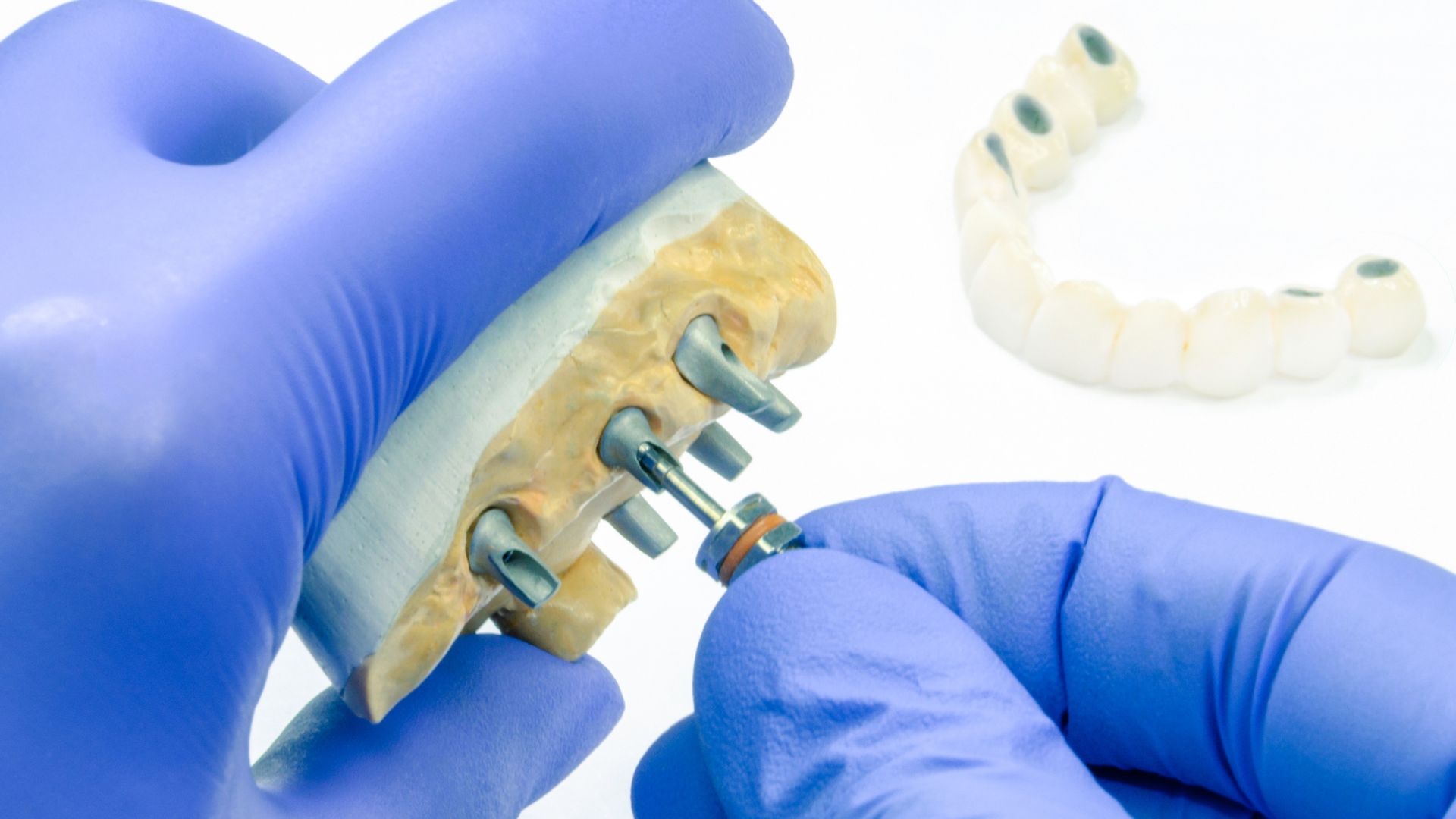 Endosteal Implants in Pico Rivera