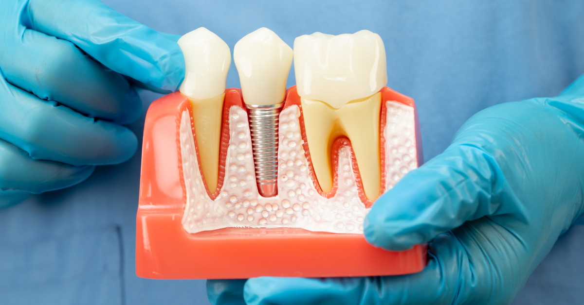 Endosteal Implants in Westchester