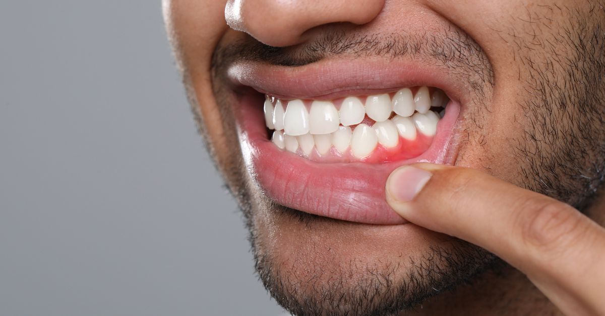 Gum Disease Treatment In Los Angeles 