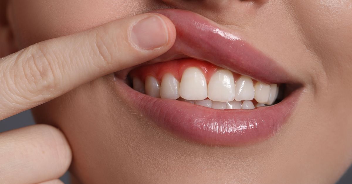 Gum Grafting for Recession in Los Angeles