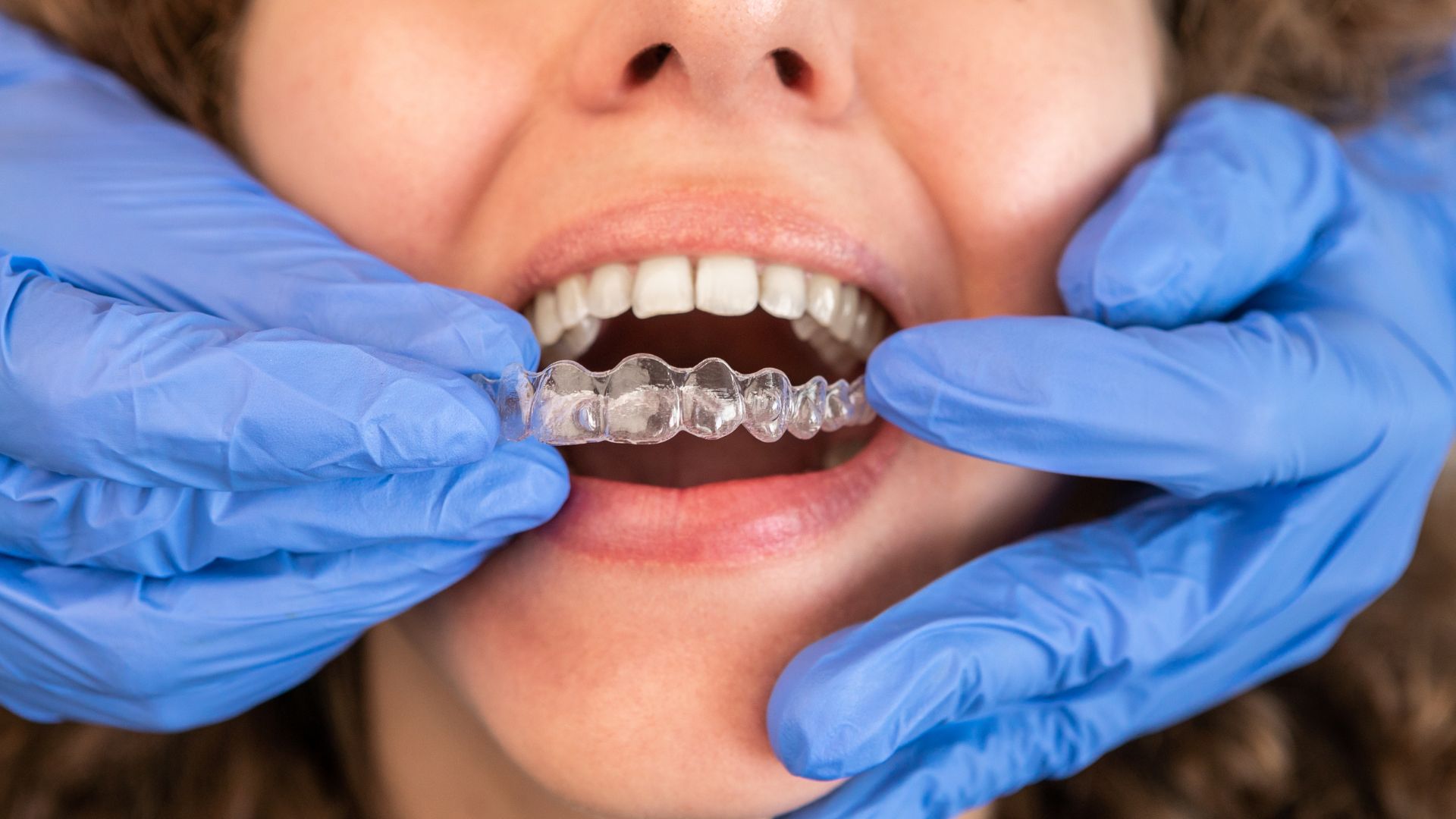 How Long Does Invisalign Treatment Take