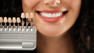 How to Know if You Are a Good Candidate for Veneers in Los Angeles