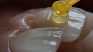 How to Prepare for Your Veneers Appointment in Los Angeles