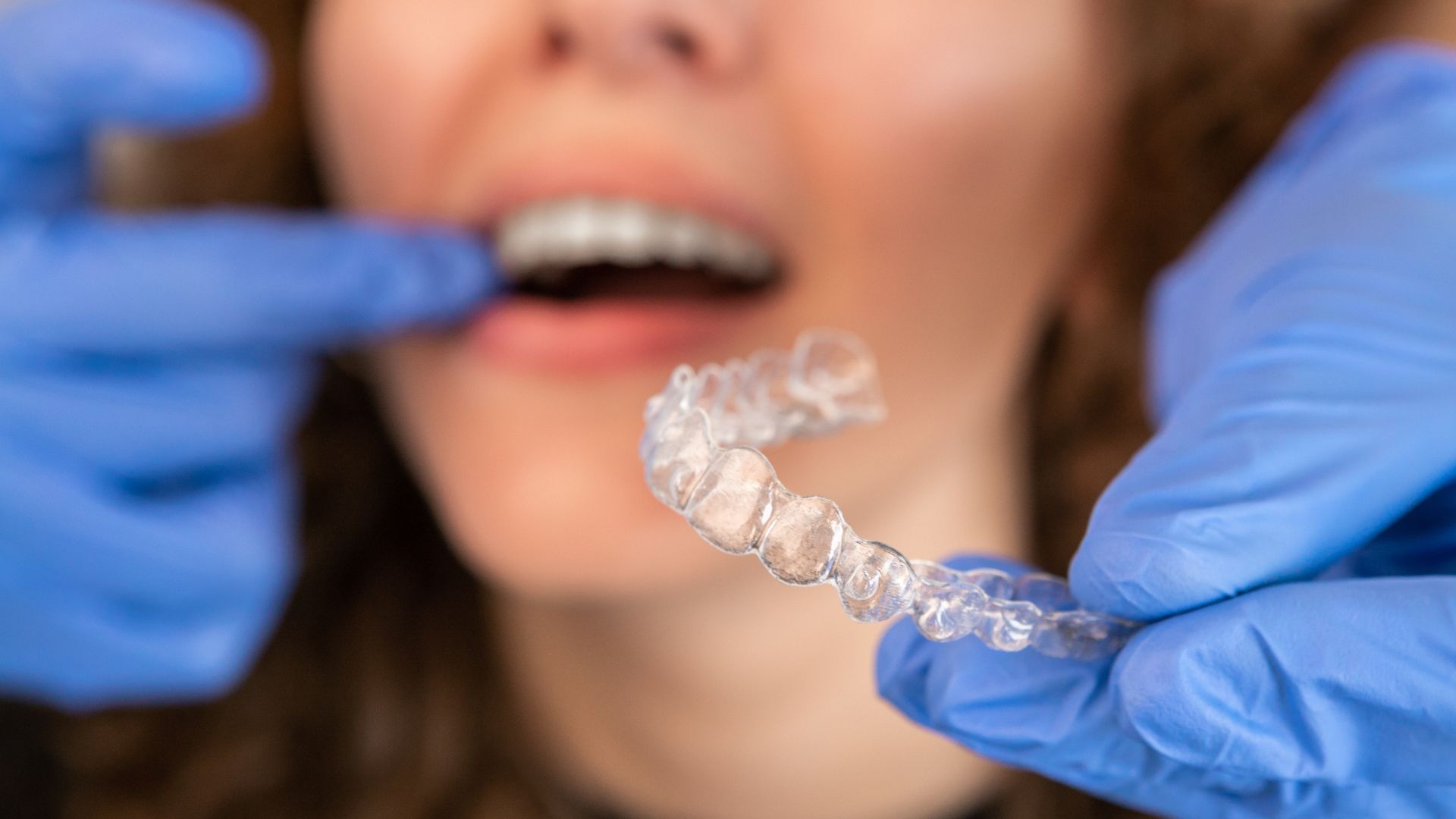 Invisalign Cost in Los Angeles What You Can Expect to Pay