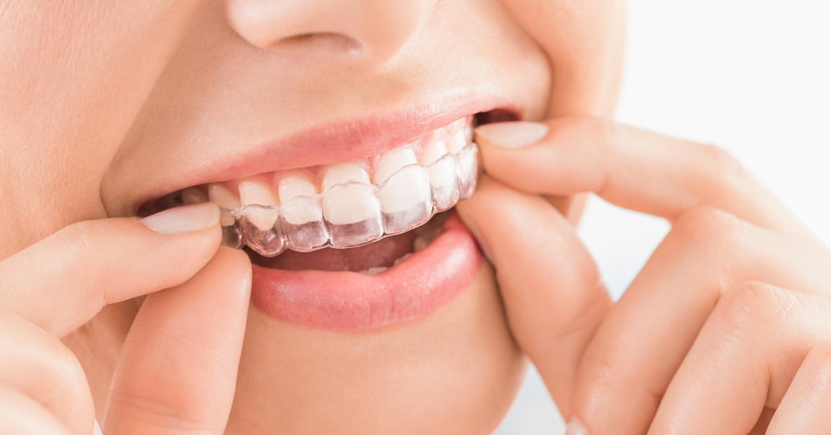 Invisalign Dentists in Westchester