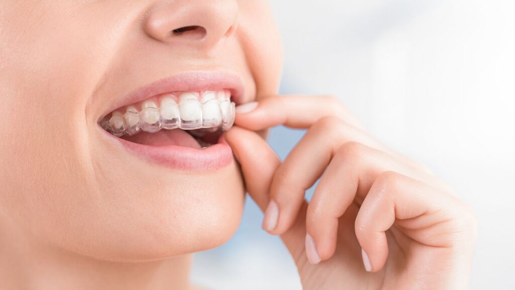 Invisalign Treatment in Los Angeles_ How Long Does It Take and What Is the Cost