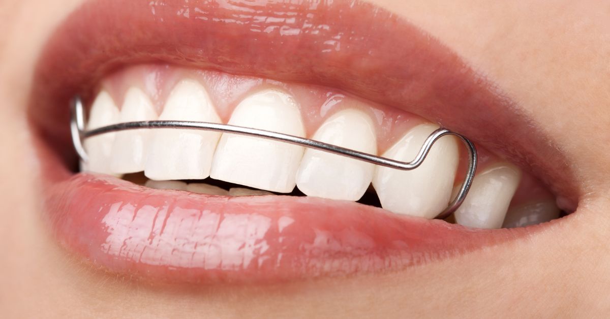 Permanent Retainers in Los Angeles