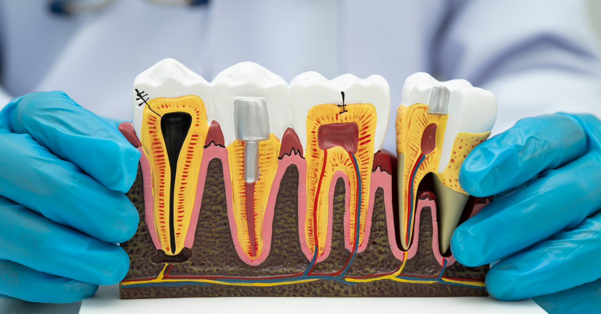 Root Canal Retreatment in Los Angeles