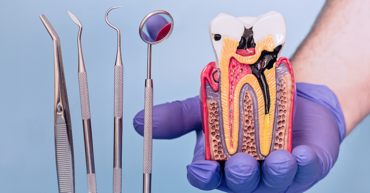 Root Canal Treatment in Los Angeles