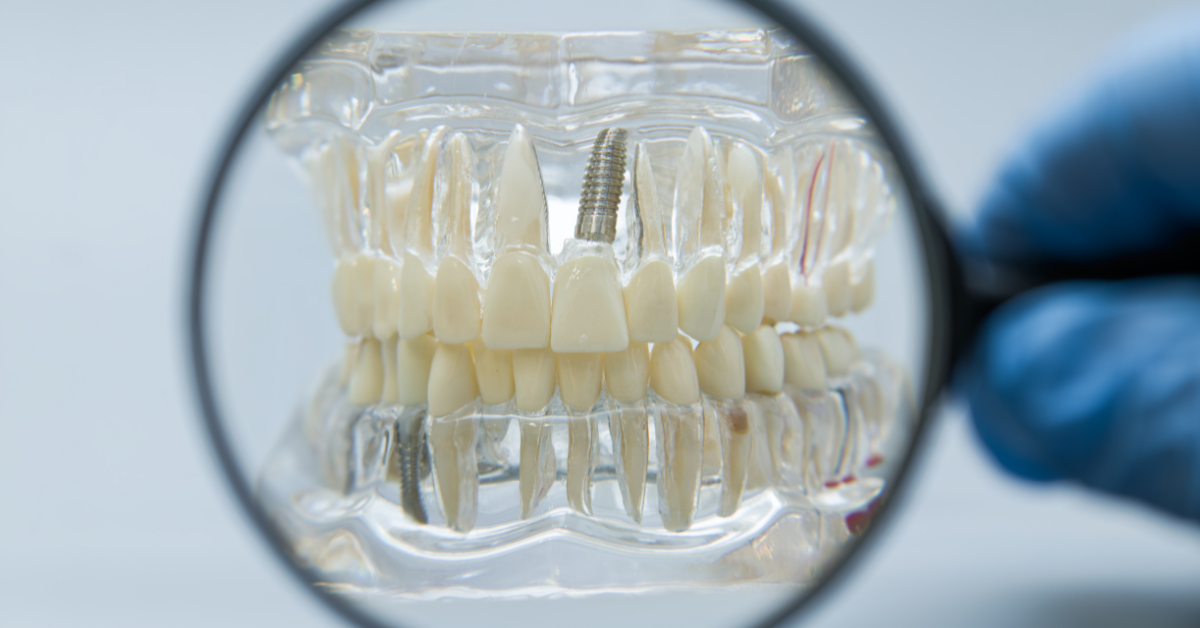 When All-on-X Dental Implants Are the Right Solution for Tooth Replacement