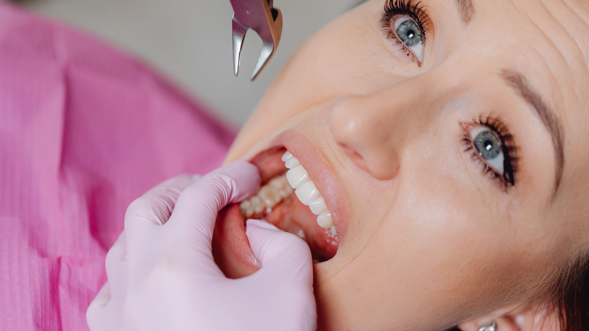 Wisdom Teeth Extractions in Pico Rivera