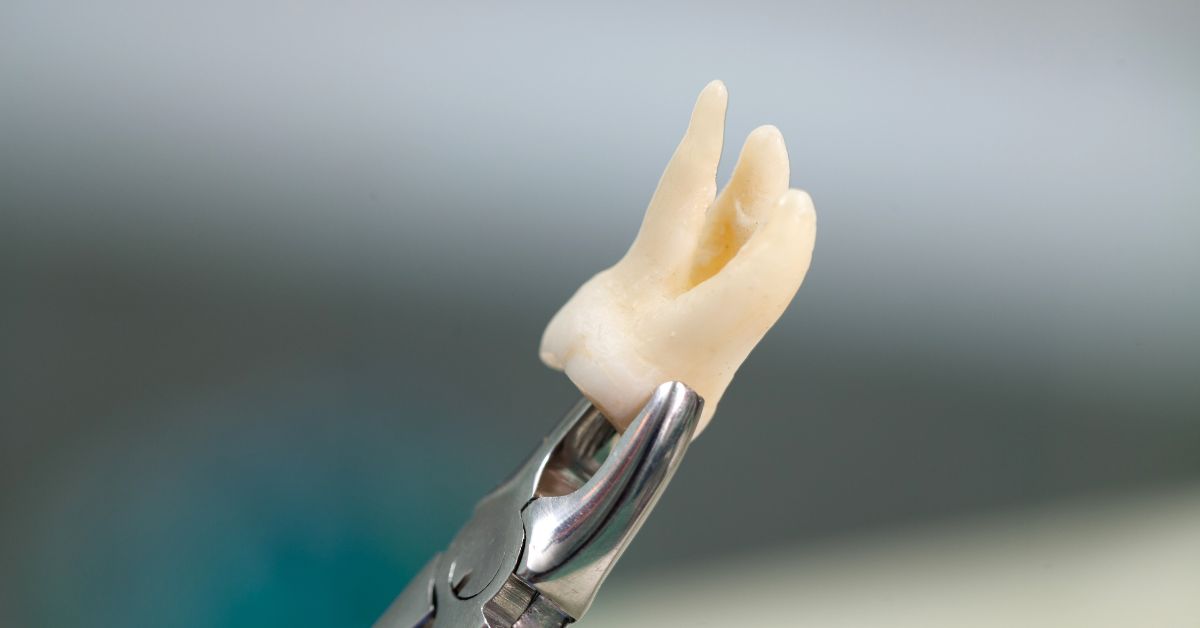 Wisdom Tooth Extractions in Los Angeles