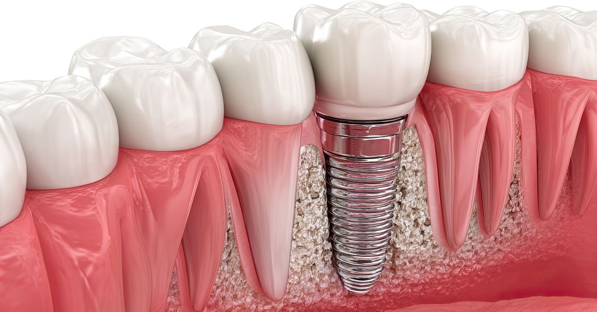 Endosteal Implants in Lynwood