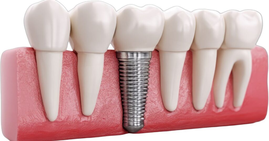 Mini Dental Implants in Inglewood