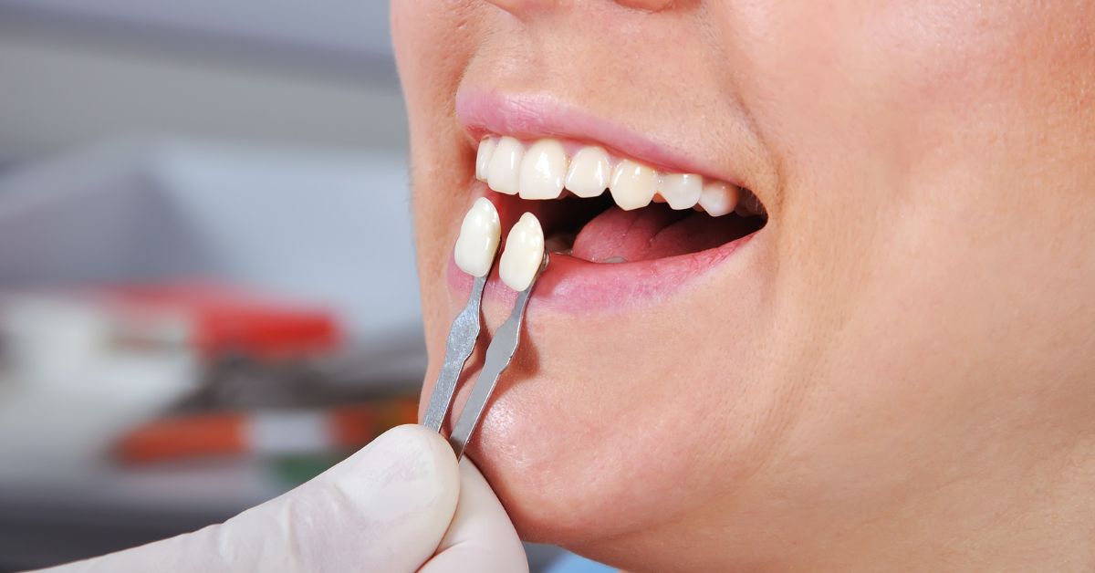 Same Day Veneers in Lynwood