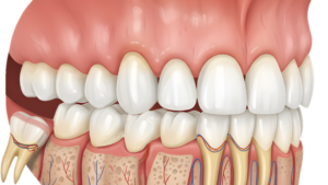 Common Procedures Included in Full Mouth Reconstruction