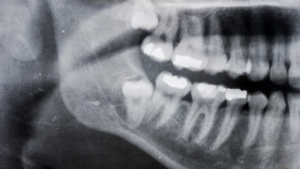 How to Prepare for Wisdom Tooth Removal in Inglewood