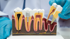 What Causes the Need for an Emergency Root Canal in Los Angeles