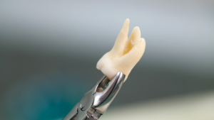 What Happens During a Wisdom Tooth Removal Procedure