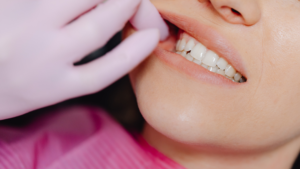What Wisdom Tooth Removal Candidates in Inglewood Should Know About the Risks and Benefits