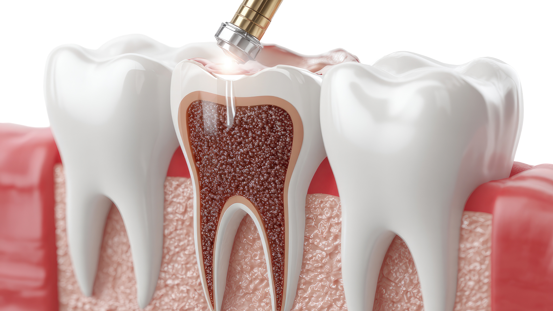 When Might Emergency Root Canals Be Necessary in Los Angeles?
