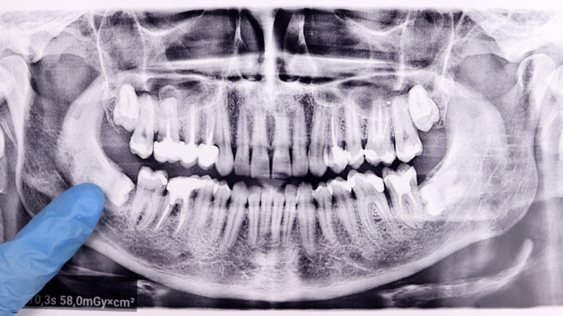 When to Schedule Wisdom Tooth Removal in Inglewood (and What to Expect)