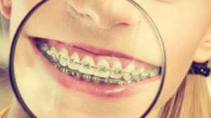 Why Go for Full Mouth Reconstruction in Los Angeles