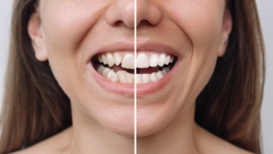 Benefits of Choosing Same-Day Veneers in Los Angeles