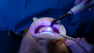The Benefits of Accelerated Orthodontics in Los Angeles for Adults