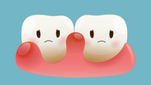 What Causes the Need for Gingivitis Treatment in Los Angeles