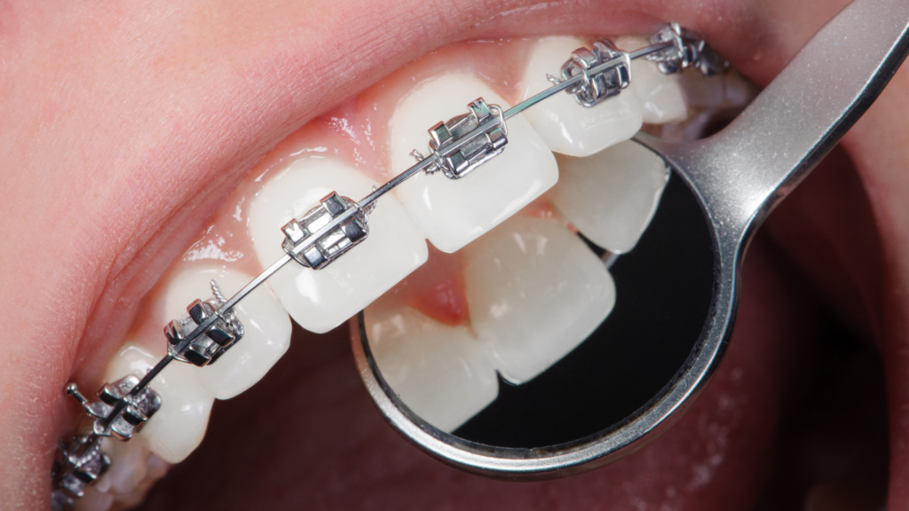 What Is Accelerated Orthodontics and When Might It Be Beneficial for Los Angeles Patients