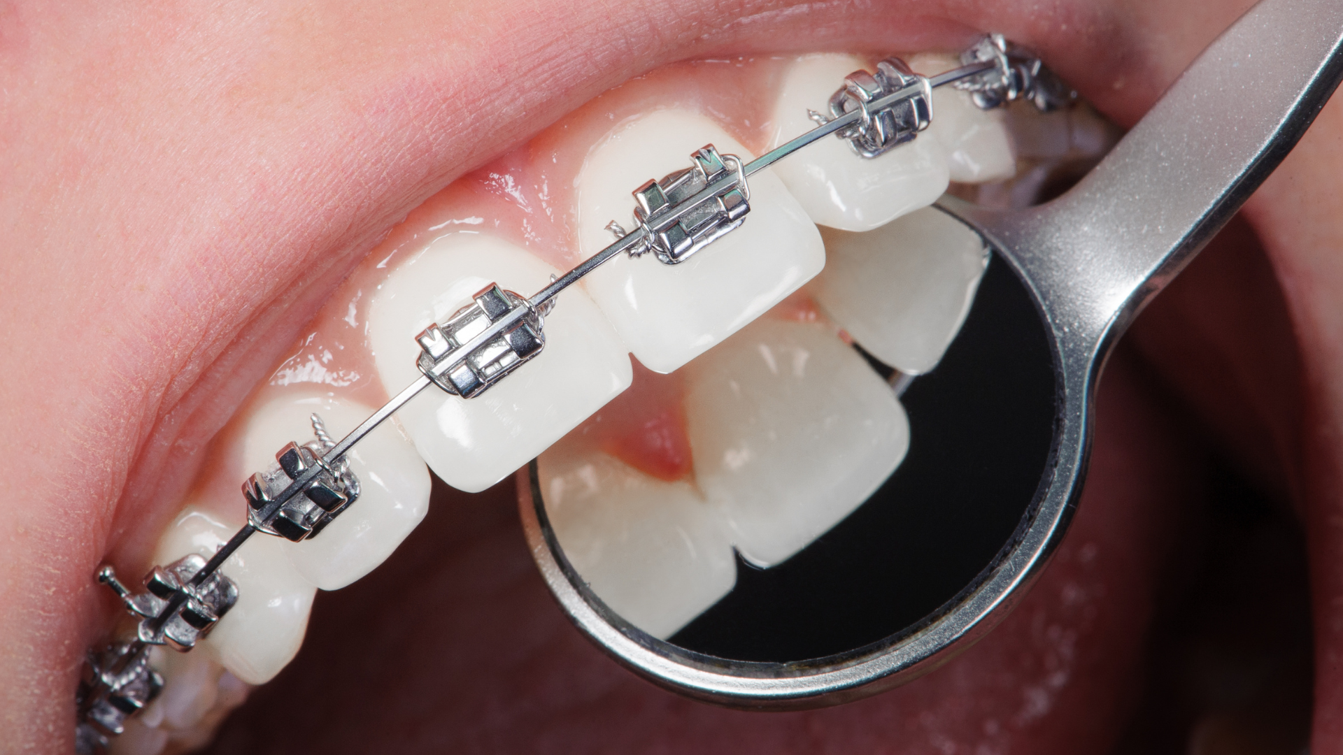 What Is Accelerated Orthodontics and When Might It Be Beneficial for Los Angeles Patients?