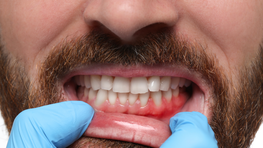 When Is Gingivitis Treatment in Los Angeles Necessary
