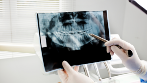 Finding Your Options in Los Angeles After a Traumatic Dental Injury Affects Your Life