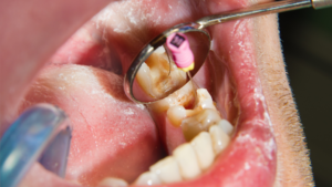 How Dentists Diagnose Root Canal Infections