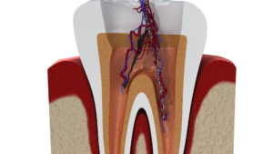 Understanding Your First Root Canal Appointment in Los Angeles