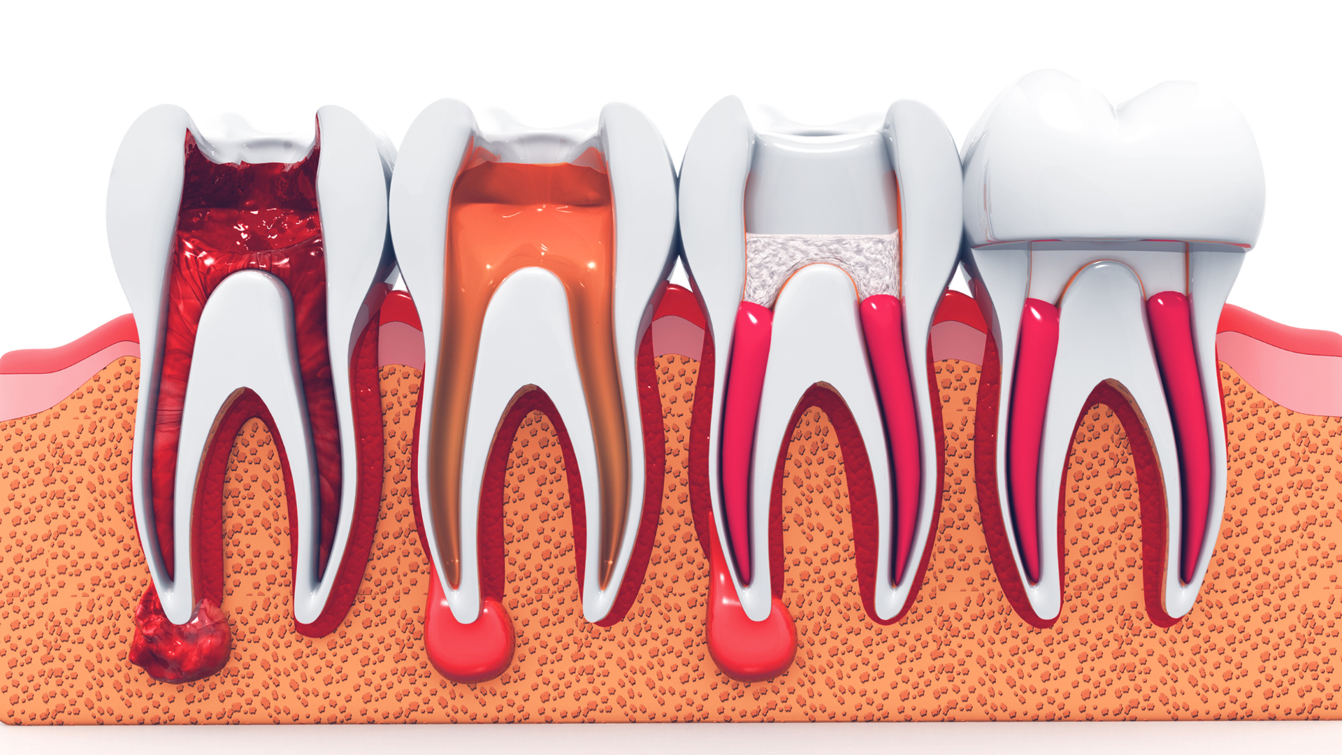 What to Know About Your First Root Canal in Los Angeles