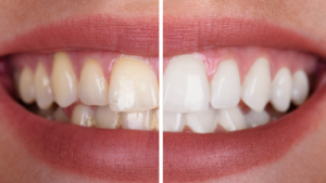 Why Professional Whitening Produces More Predictable Results