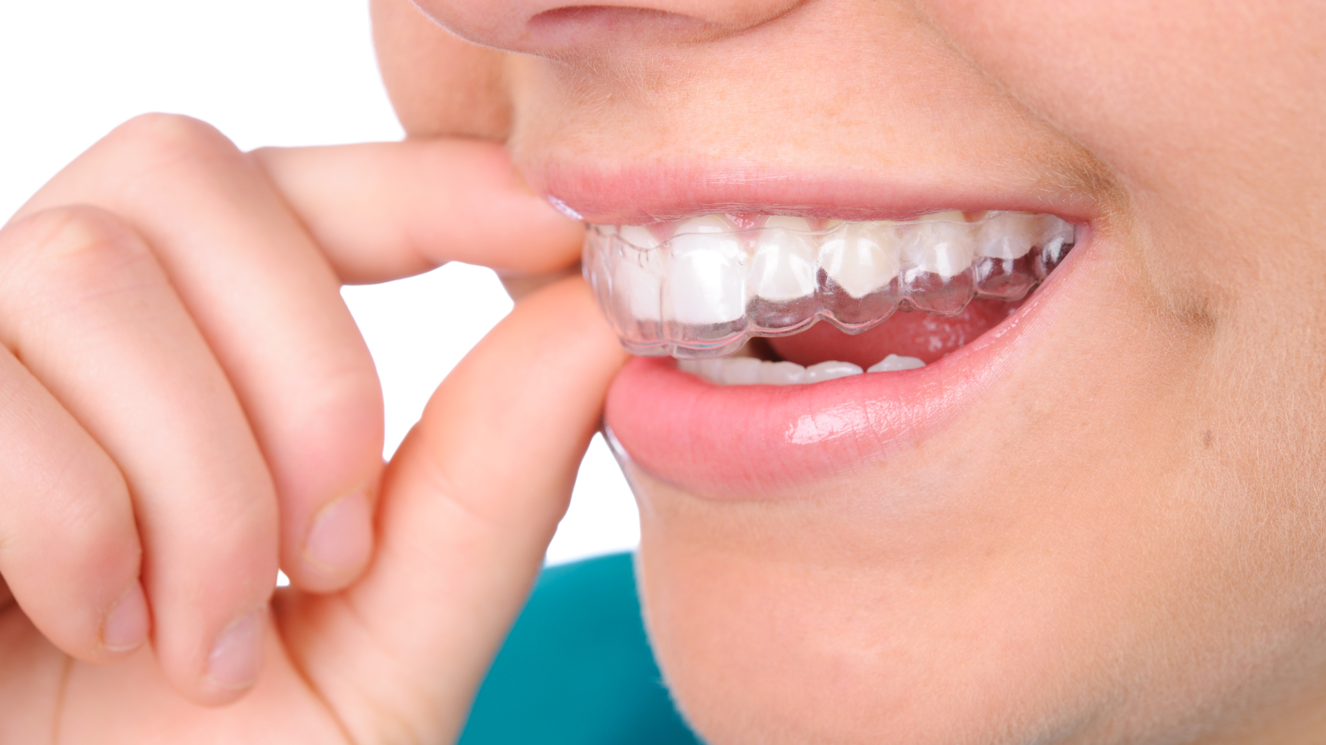 Why Get a Permanent Retainer Over a Plastic One in Los Angeles?