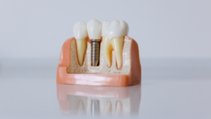 How Mini Dental Implants in Los Angeles Differ From Traditional Dental Implants