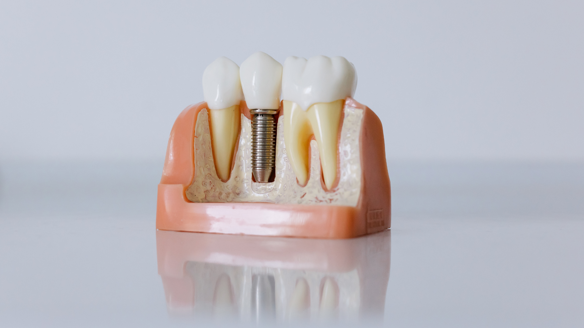 All-on-X Dental Implants in Norwalk
