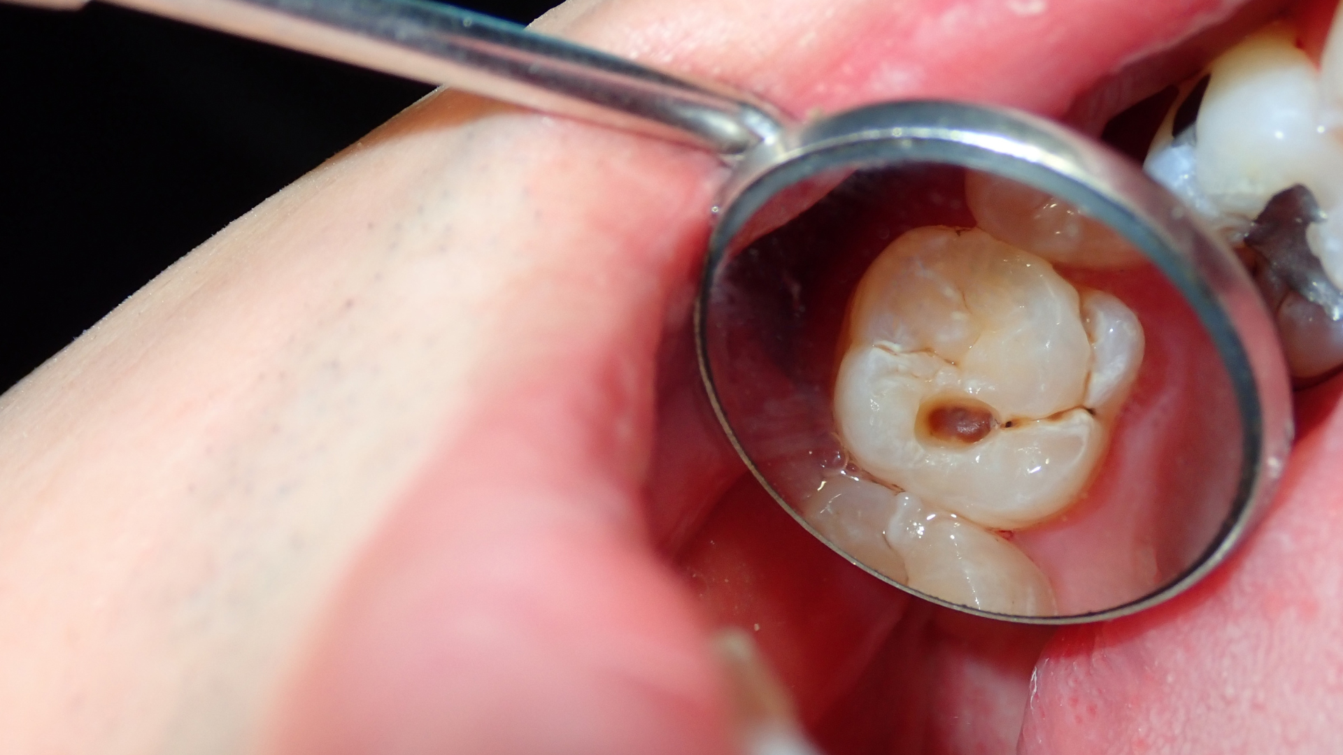 How a Pediatric Dentist in Los Angeles Helps Prevent Cavities From an Early Age