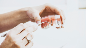 Schedule an Appointment for Your Mini Dental Implants in Los Angeles Today