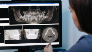 When to Consider Mini Dental Implants in Los Angeles After Tooth Loss