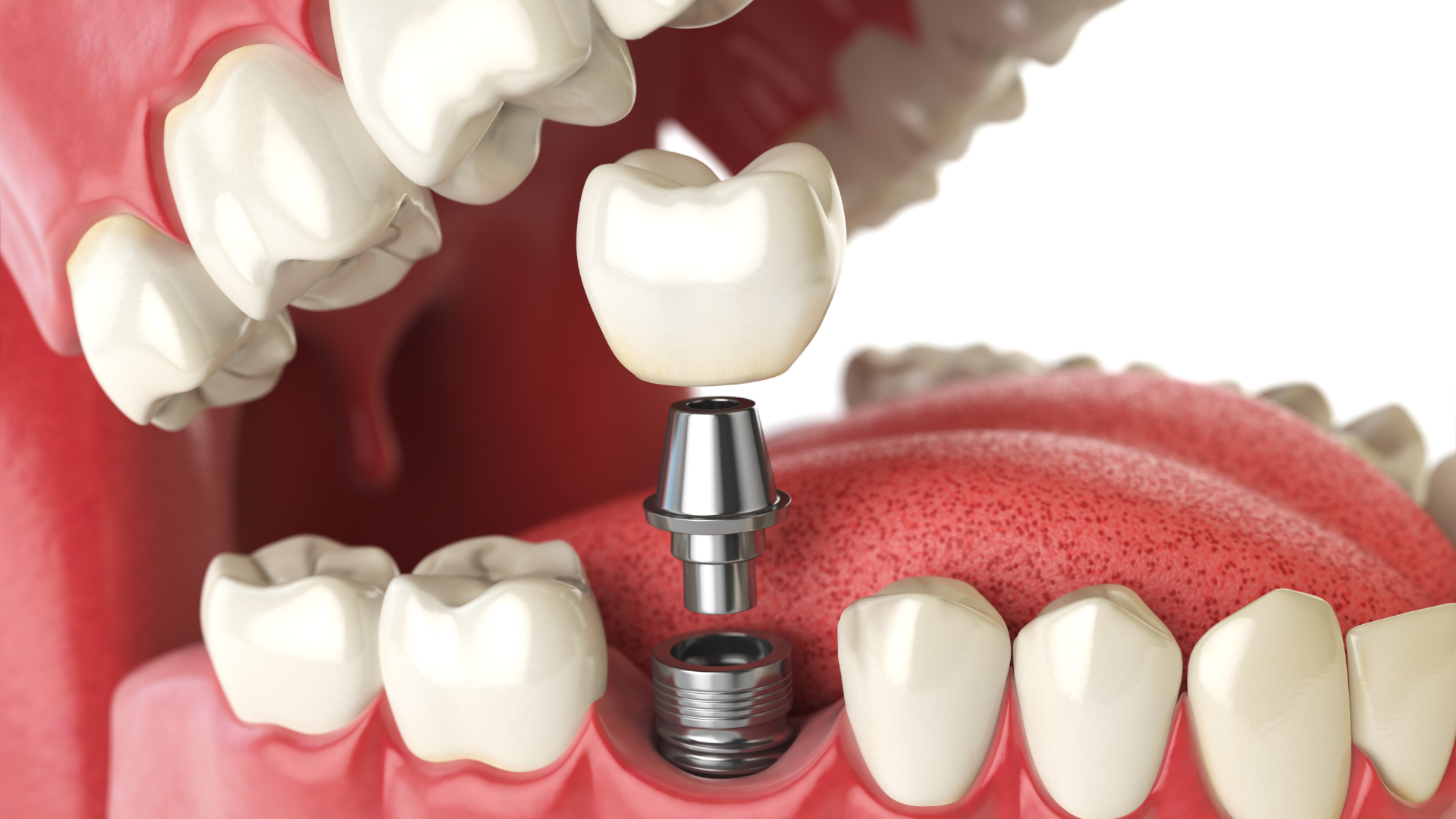 Who Are Mini Dental Implants For (And What to Consider Before Getting Them)